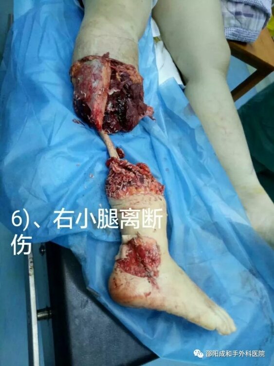 邵陽創(chuàng)傷骨科,邵陽風(fēng)濕病區(qū),邵陽骨質(zhì)增生,邵陽關(guān)節(jié)病區(qū),邵陽頸椎病區(qū) 邵陽創(chuàng)傷骨科,邵陽風(fēng)濕病區(qū),邵陽骨質(zhì)增生,邵陽關(guān)節(jié)病區(qū),邵陽頸椎病區(qū)